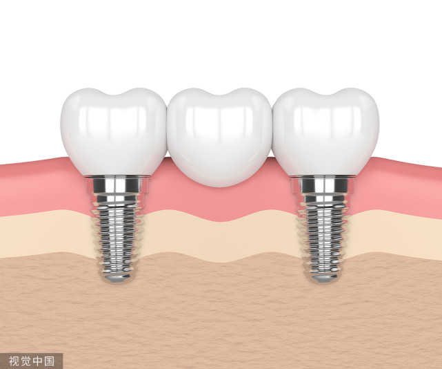 度过了手术的恢复期后,日常又该怎么护理种植牙呢?