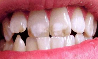 如果牙齿就该是淡黄色,难道我们天生牙白的才不健康?