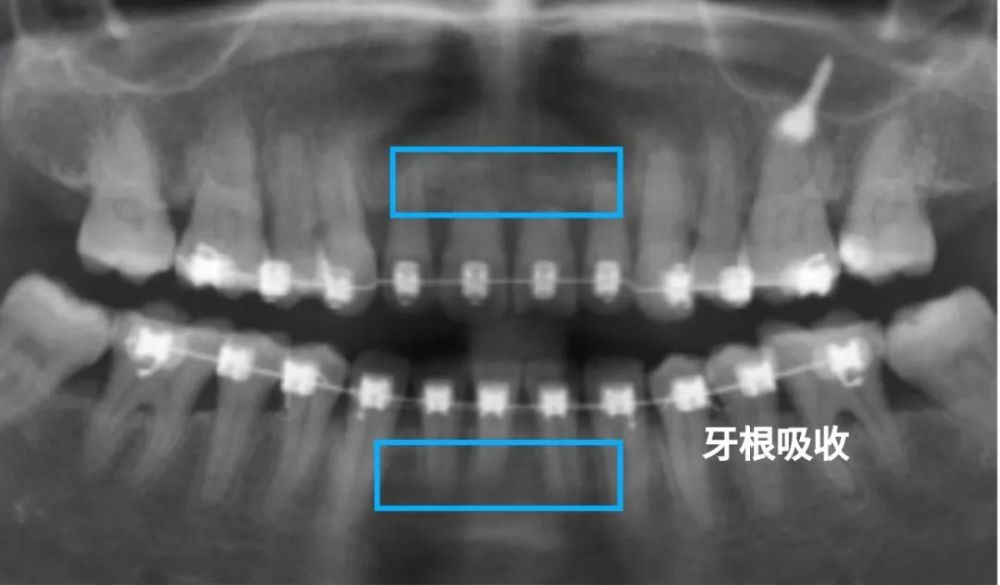 还不知道什么是牙根吸收掉牙预警