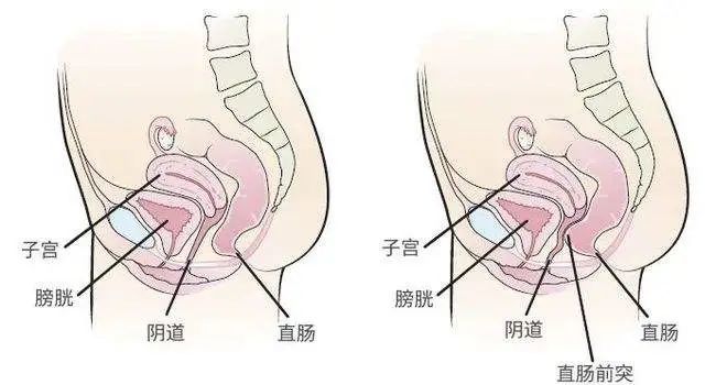 直肠前突怎么回事?