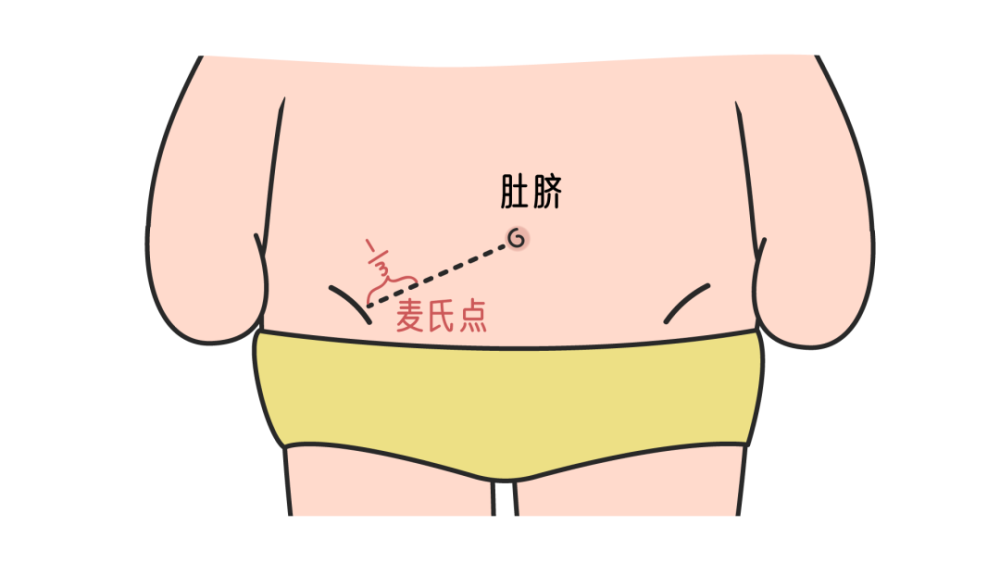 麦氏点,也就是我们常说的阑尾点,位于肚脐和右髂前上脊连线中外三分之