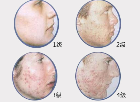 痤疮按严重程度分4级你是哪一级另附一份有效治疗方法建议收藏