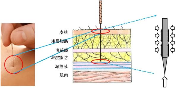 瘢痕的针灸治疗