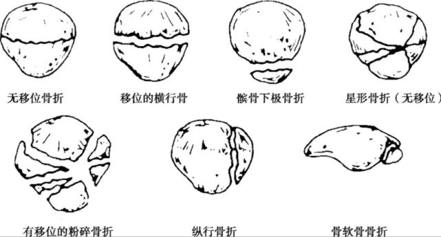 骨科精读|干货:髌骨骨折的核心技术要点,一文囊括!