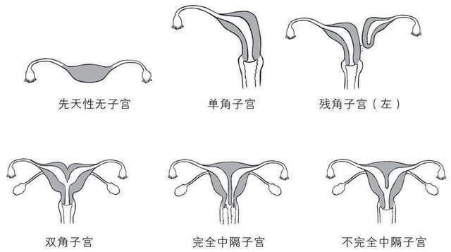 其实是属于痕迹子宫,是属于先天性子宫发育不良,属于子宫畸形的一种