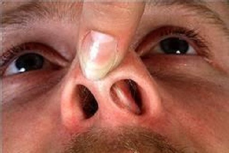 蛙状鼻容易与哪些症状混淆