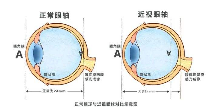 儿童青少年视力发育正常值,看看你家孩子合格吗?