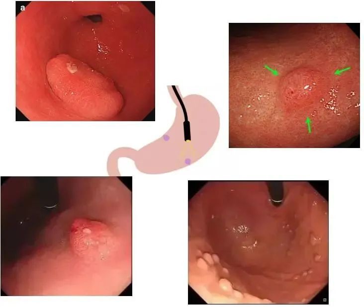科普您一定要知道的胃息肉的那些事儿