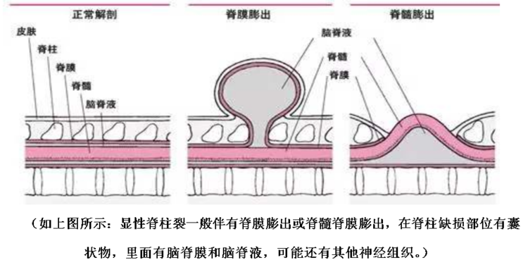 先天性脊柱裂脊膜膨出的治疗及案例分享