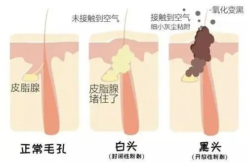 肤康科普史上最全图文解说痤疮的症状病因及治疗方案