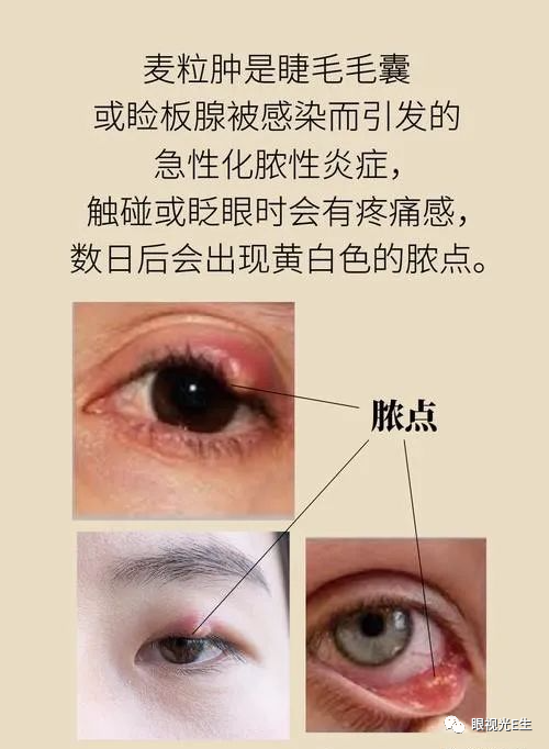 如何正确诊断麦粒肿vs霰粒肿