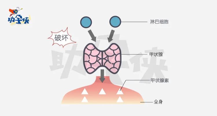 易被忽视的免疫问题桥本甲状腺炎