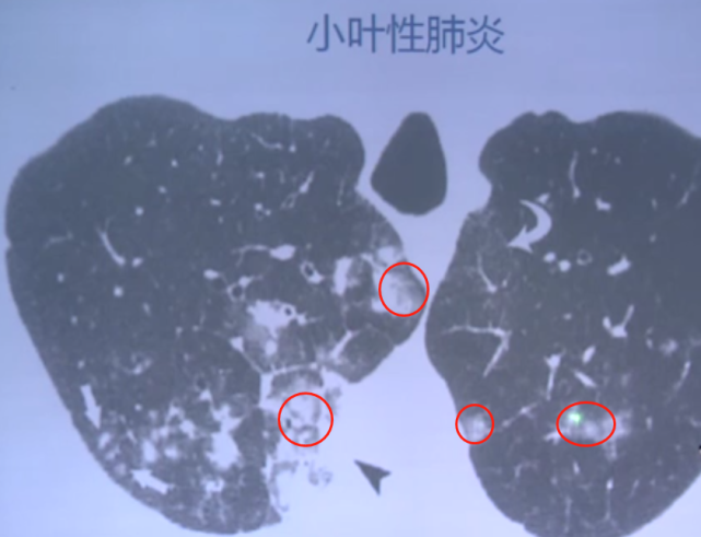 病例2:下图的小叶性肺炎甚至在上肺叶都有渗出(把肺纹理遮盖),还有些