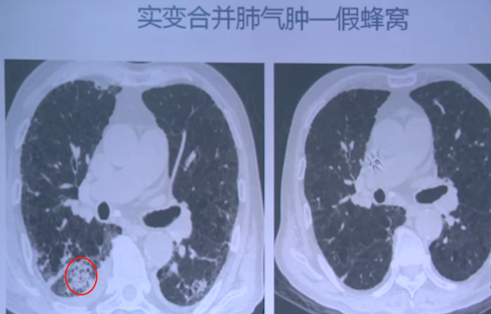 病例3:实变合并肺气肿—假蜂窝图4复查后病变吸收消散,可以发现整体