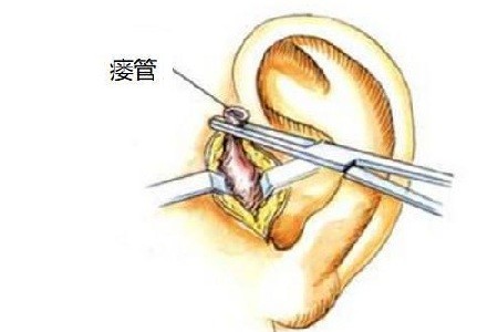 如何预防耳前瘘管发炎