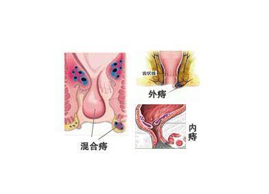 痔疮如何形成的经历过的人都觉得后怕还会反复