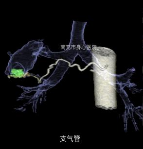 支气管扩张,支气管动脉瘤,肺癌,肺内转移瘤和支气管动脉栓塞术前评估