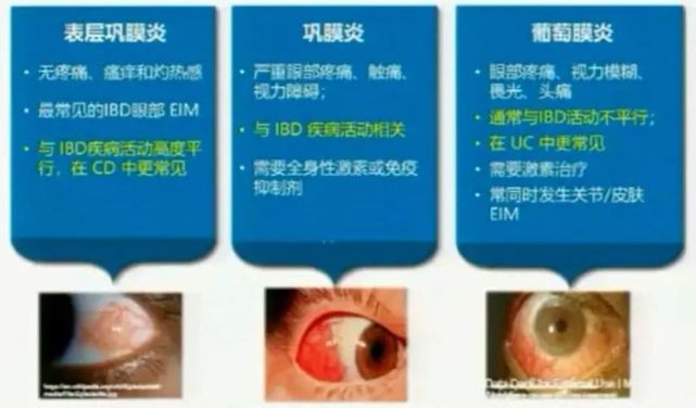 图3 ibd常见眼部病变表层巩膜炎:特征是单眼或双眼急性充血伴有轻度