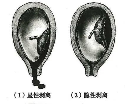 显性剥离时血液经阴道流出,隐性剥离时血液积聚在子宫壁与胎盘之间