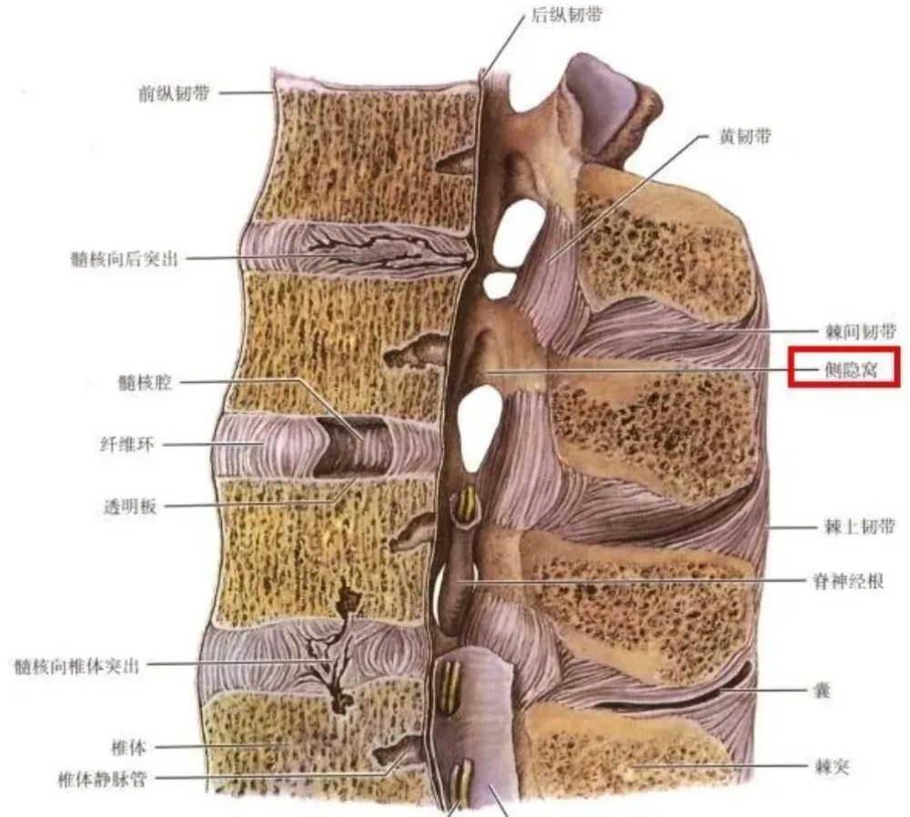 1982 mar; 26(1): 13–20下腰椎正常侧隐窝(箭头)的横断面图,椎孔呈