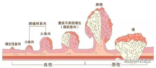 第二,腺瘤样息肉.为什么炎性息肉也会恶变?