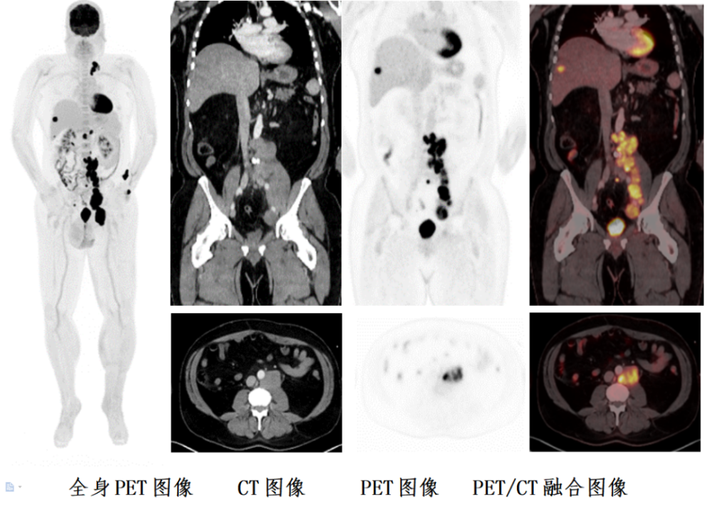 提升检查体验;■ 磁悬浮病人载控系统,亚毫米进床精度,保证pet/ct融合