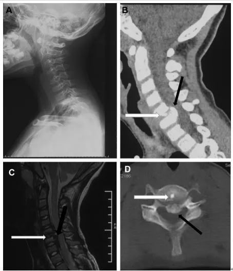 图:8岁女孩,因颈腰痛伴左上肢放射痛2月余就诊,颈椎侧位片,ct和mri