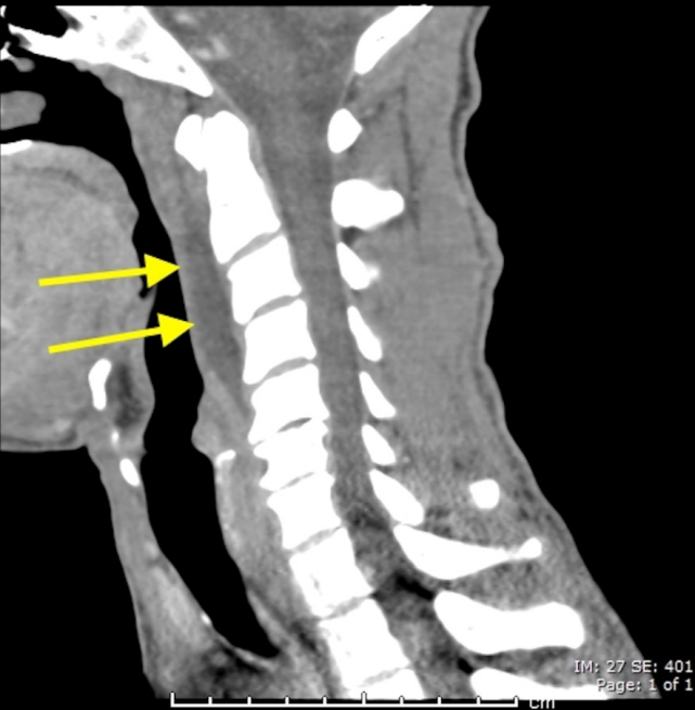 图:椎前软组织肿胀颈椎侧位片能够显示上颈椎前纵韧带和颈长肌组成的
