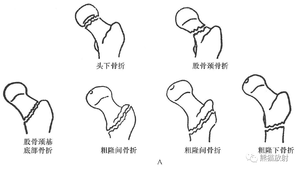 示意图;b.股骨颈头下骨折,左侧股骨颈头下部骨质连续中断:c.