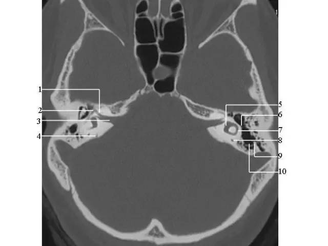 前庭7.砧骨短脚6.锤砧关节5.锤骨头4.前庭窗3.面神经管鼓室段2.耳蜗1.