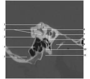 乳突气房5.乙状窦6.总脚7.耳蜗8.镰状嵴9.颈动脉管10.单孔11.