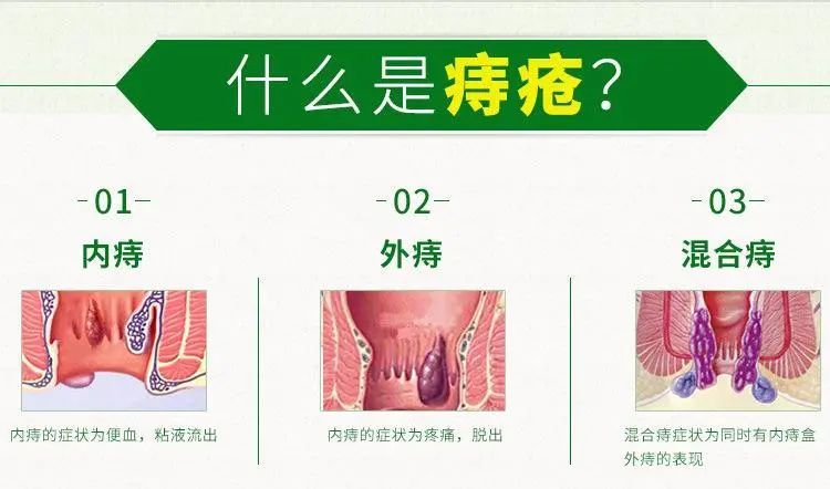 混合痔的症状痔类疾病中,混合痔比较难治,因为它有容易反复发作的特性