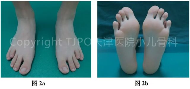 tjpo儿童矫形科普11mini轨道外固定支架矫正跖骨短缩畸形