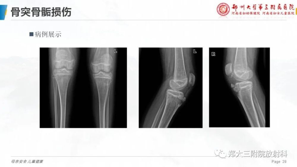 儿童骨折是难点尤其是骨骺损伤