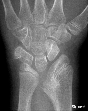 腕关节x线高清解剖 腕骨脱位典型病例