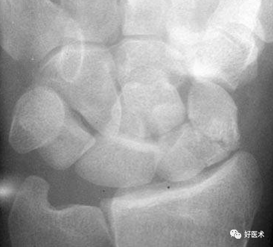 赞腕关节x线高清解剖腕骨脱位典型病例