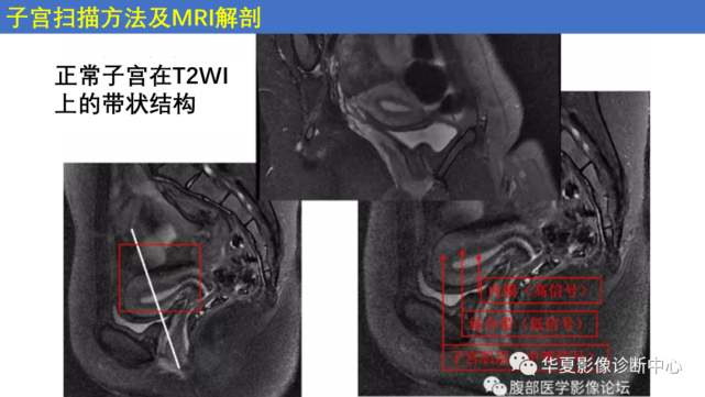 子宫内膜疾病的mri诊断及鉴别