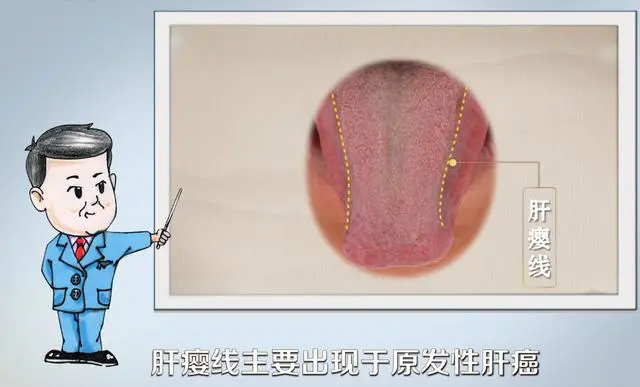 医生提醒癌变前耳朵舌头会求救厚白苔肺癌肝瘿线肝癌