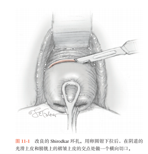 妇产基本功宫颈环扎怎么做手术技巧你知道吗看这篇就对了