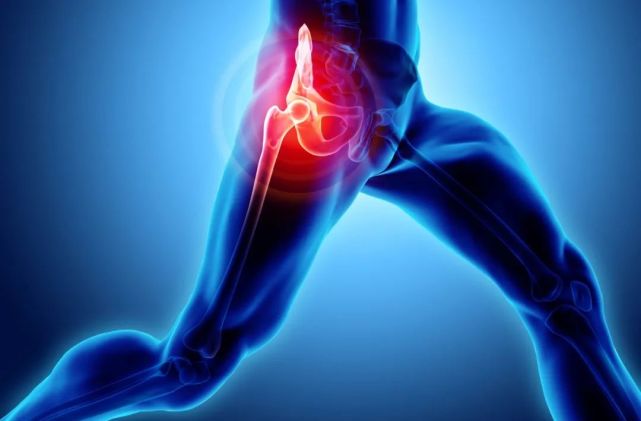 大转子疼痛综合征(gtps)表现为大转子及其周围疼痛,可放射至大腿外侧