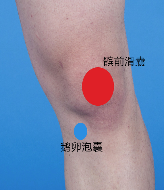 髌前滑囊(如下图)位于膝盖前方的髌骨和皮下组织之间.
