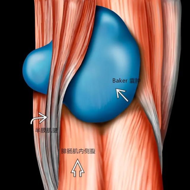 腘窝内侧腓肠肌-半膜囊因液体膨胀而形成腘窝囊肿或贝克囊肿.