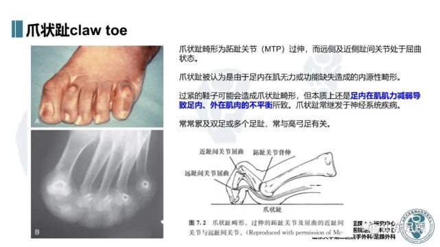 一文了解|外侧趾畸形的发病机制与术前评估