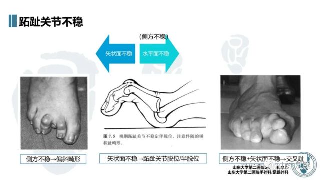 一文了解|外侧趾畸形的发病机制与术前评估