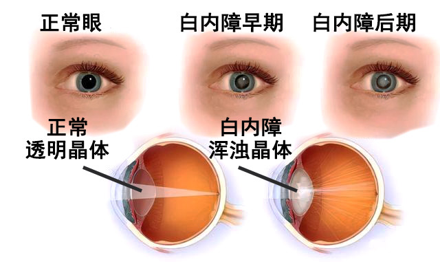 白内障是每个老年人都迈不过去的坎陈彬川教授表示其实