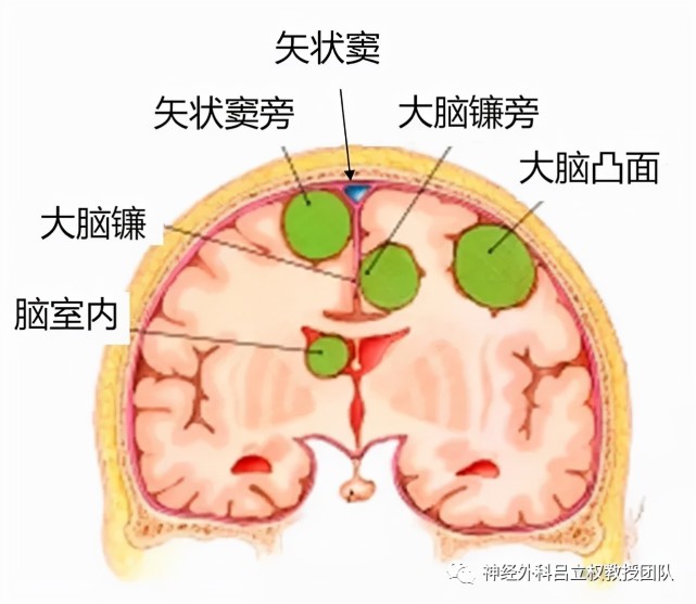 其他包括嗅沟,大脑镰,岩骨,天幕,后颅窝,脑室等.有一