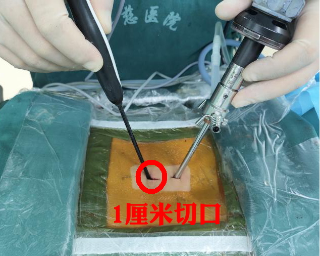 术中1厘米切口一个起身,腰疼腿麻不能动63岁的李大爷(化名),一周前搬