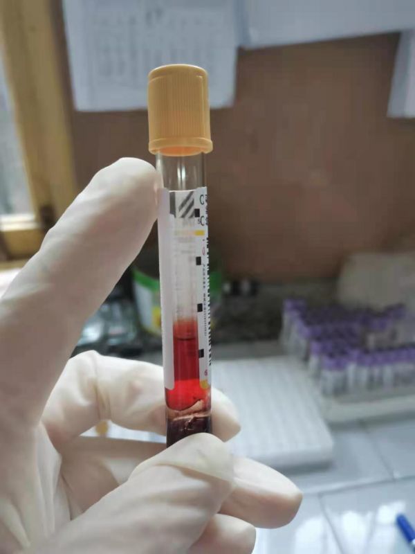 红色血浆溶血会导致红细胞破裂,使红细胞内的血红蛋白被释放出来,跟