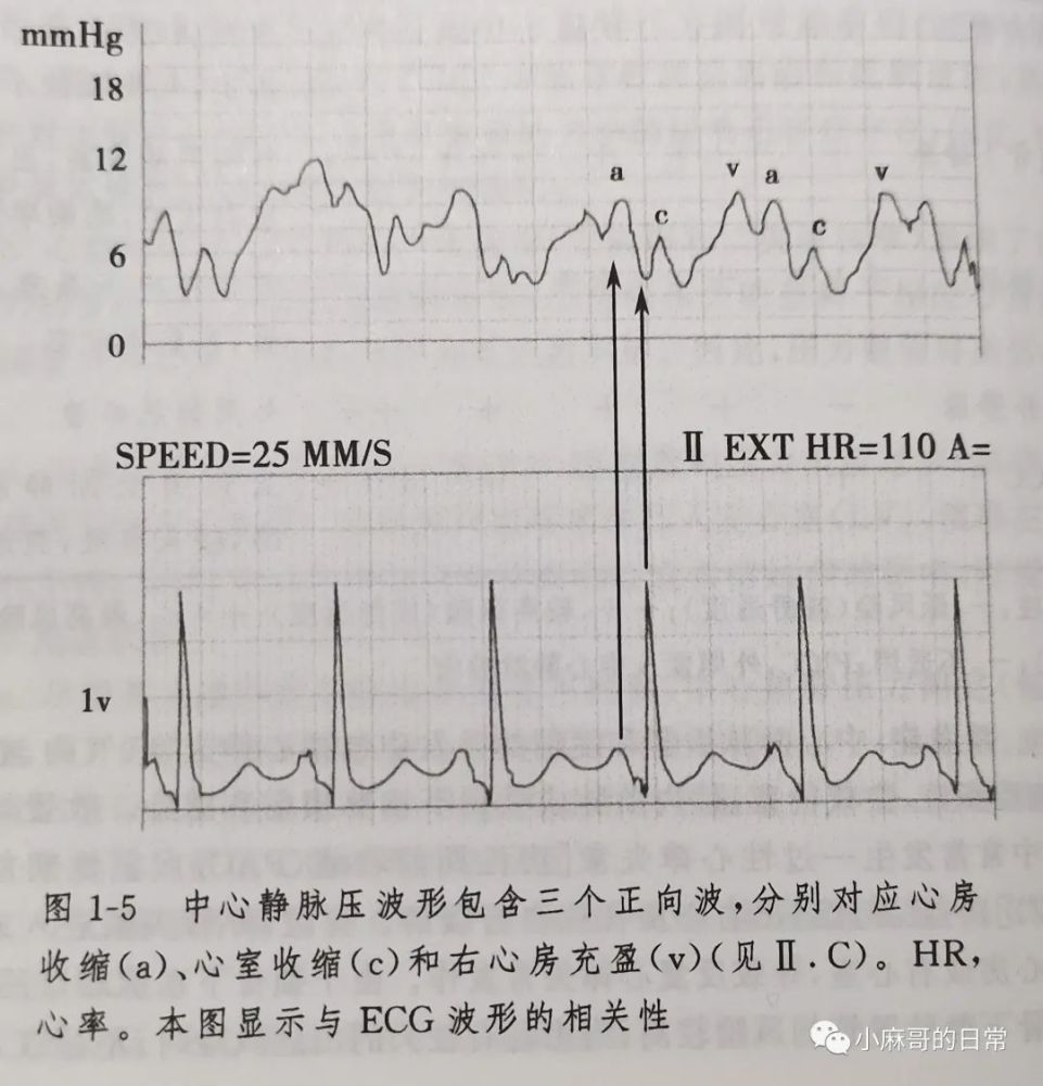 cvp波形异常的常见原因