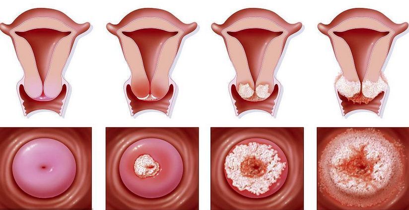 贝安健康宫颈糜烂分为哪三种程度